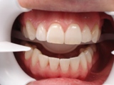 After Invisalign and Porcelain Bridge