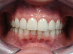 After Porcelain Veneers