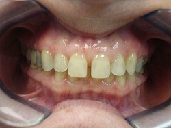 Before Porcelain Veneers