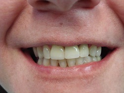 Impant crowns