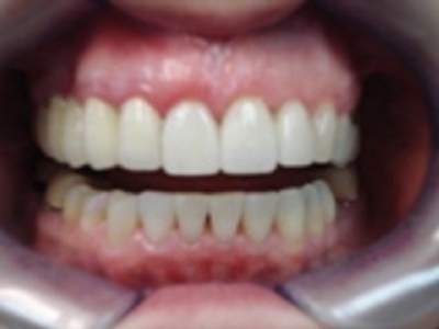 Porcelain Veneers and Invisalign