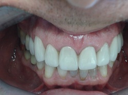 Porcelain Crowns and Veneers