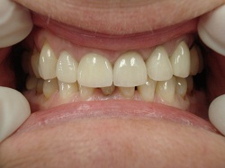 Porcelain Crowns