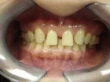 Before Invisalign and Porcelain Veneers