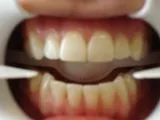 Before Invisalign and Porcelain Bridge