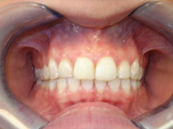 Before Porcelain Veneers