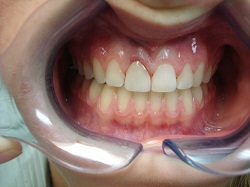 Cosmetic Bonding