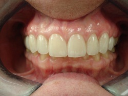 After Porcelain Veneers