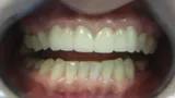 After Invisalign and Porcelain Veneers